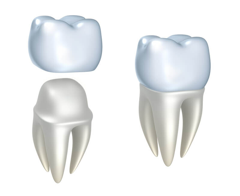 Dental Crowns Cary NC