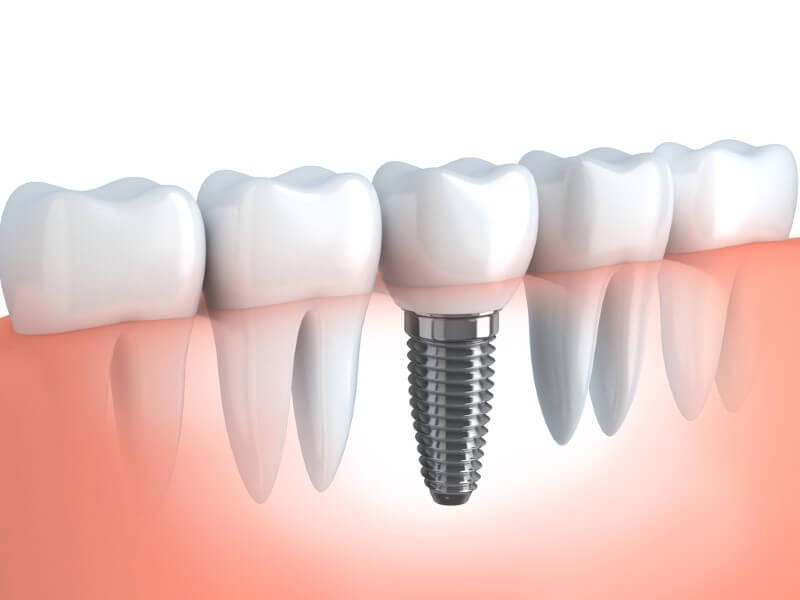 Dental Implants Cary NC