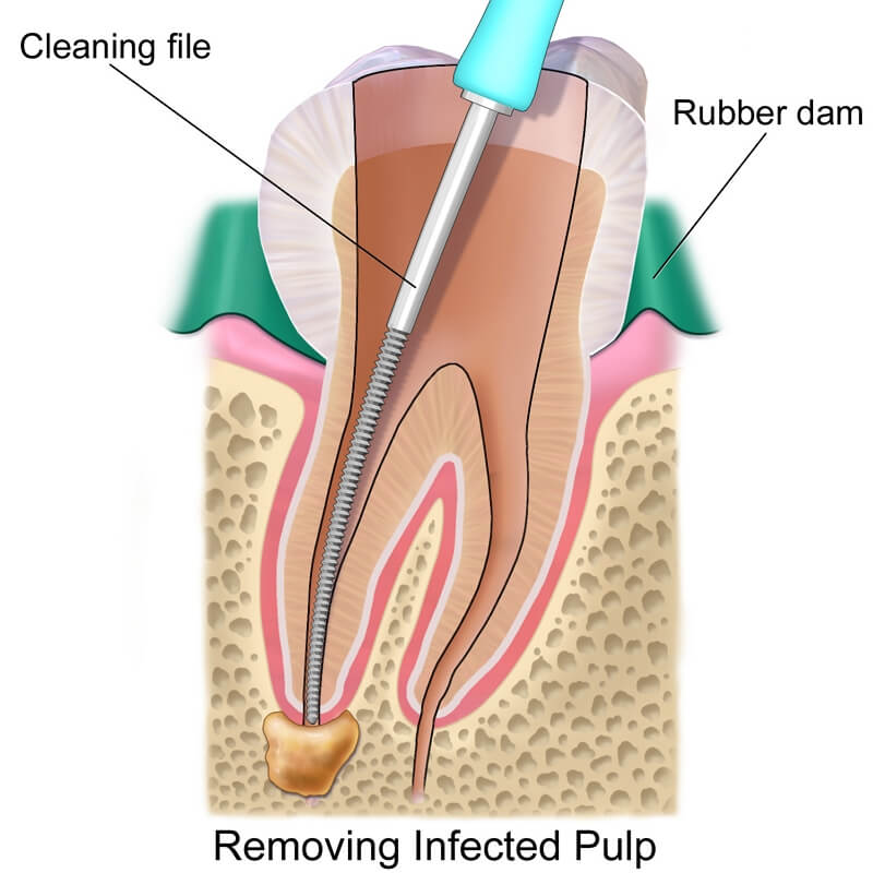 Root Canal Cary NC